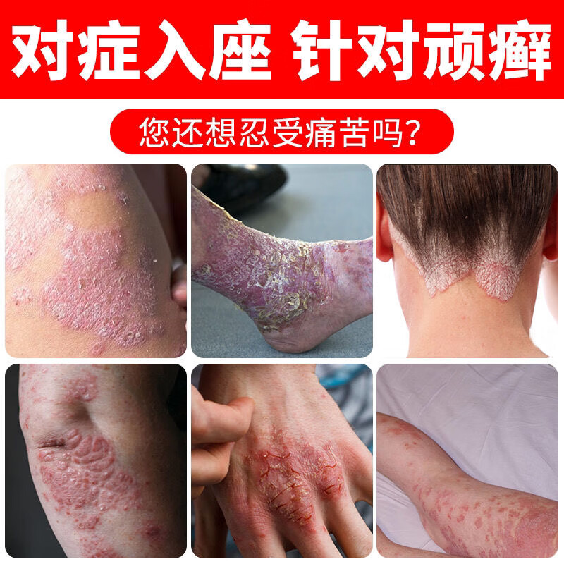 牛皮l癣溢脂性皮l炎湿l疹l疱l疹抑菌膏皮肤瘙痒止痒膏干燥脱皮外用