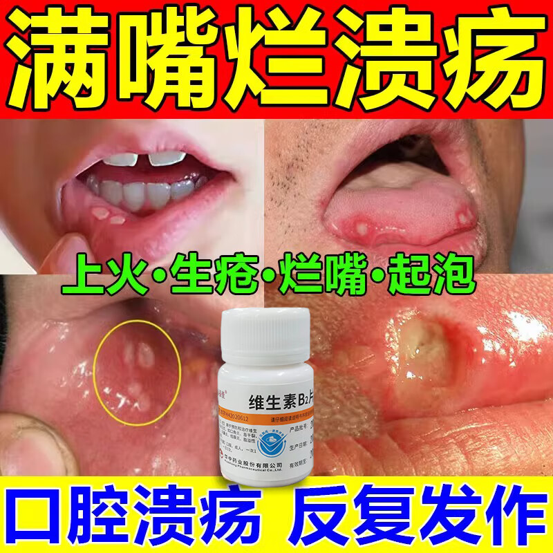 治口腔溃疡的药 经常口腔溃疡吃什么药嘴巴烂口舌生疮反复溃疡溃烂