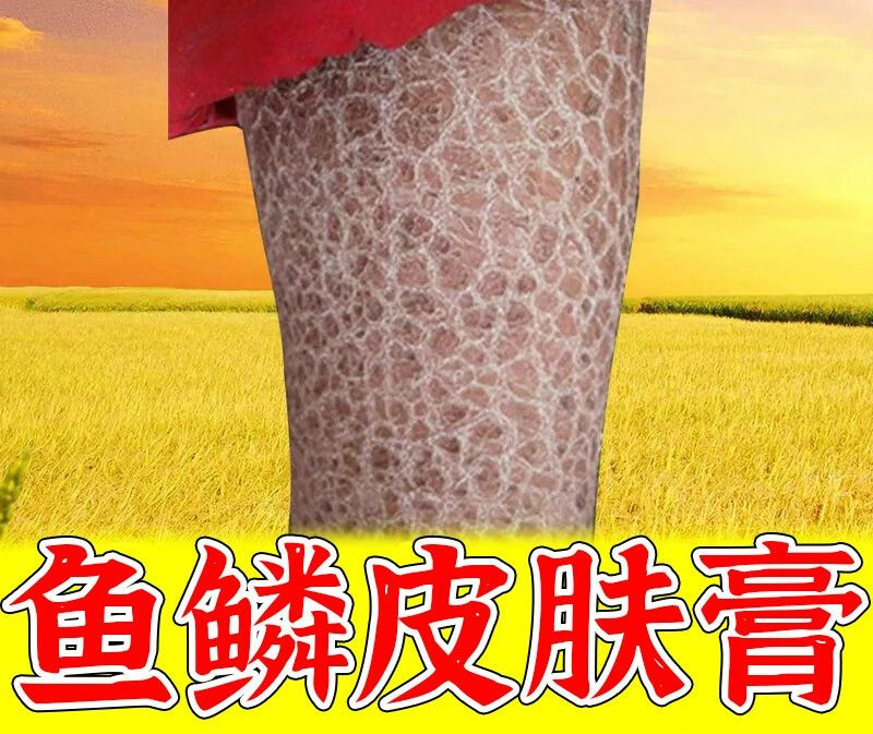 鱼鳞皮肤膏 适用于鱼鳞蛇皮病干燥脱皮屑鸡皮肤疙瘩毛囊角化保湿 单