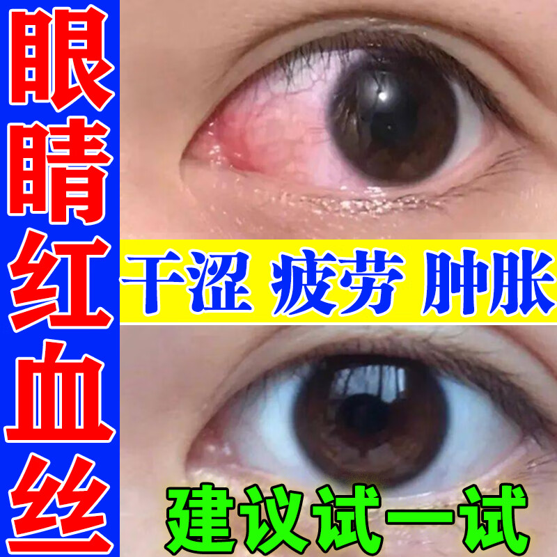 眼睛红血丝眼非药水滴眼液眼部疲劳结膜充血视力模糊眼睛酸胀干涩痛痒