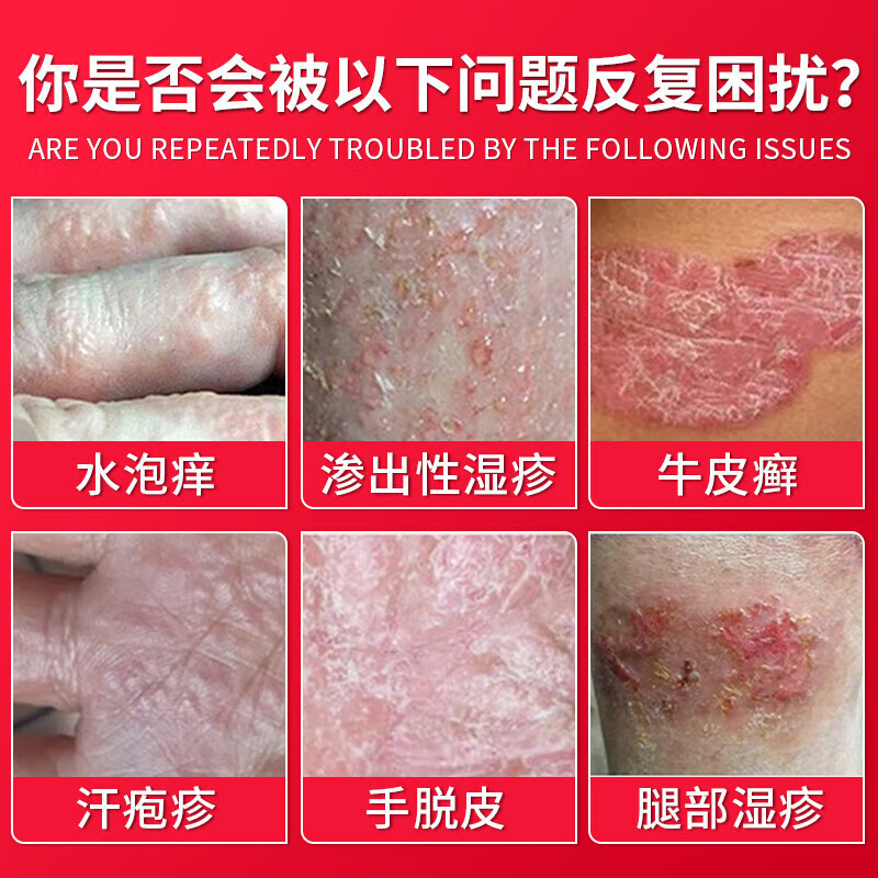 纾大夫阴囊炎阴囊潮湿瘙痒脱皮睾丸瘙痒大腿内侧屁股抑菌止痒膏皮肤瘙痒 双效三盒巩固装