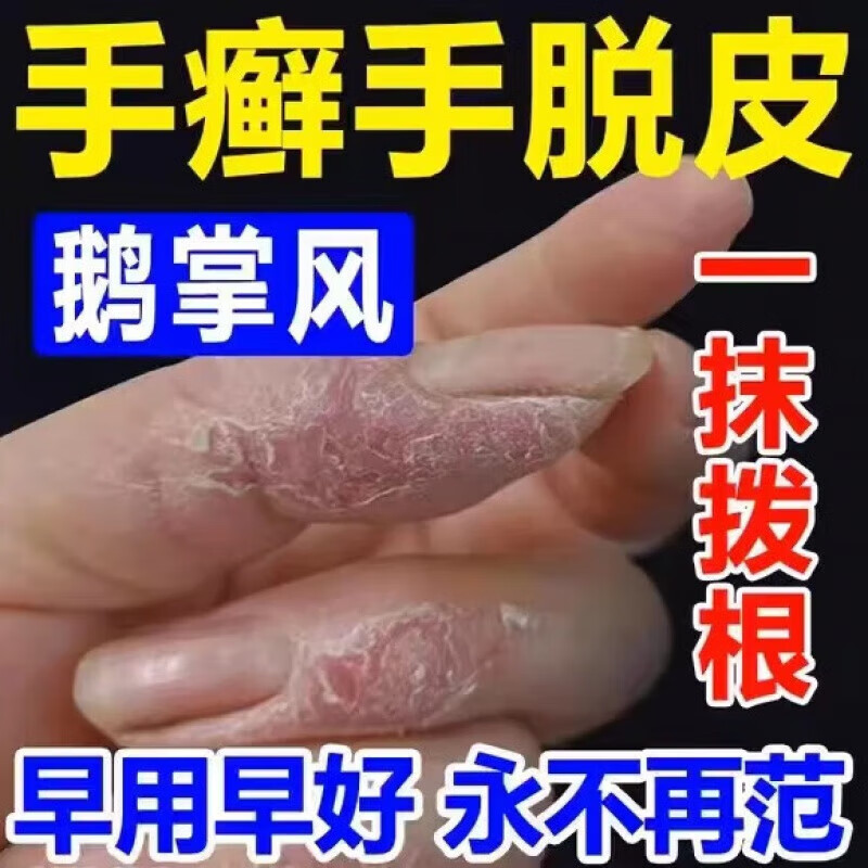 手癣真菌感染药膏】治手癣脱皮鹅掌风皮肤痒干裂起泡汗疱疹红斑止痒念