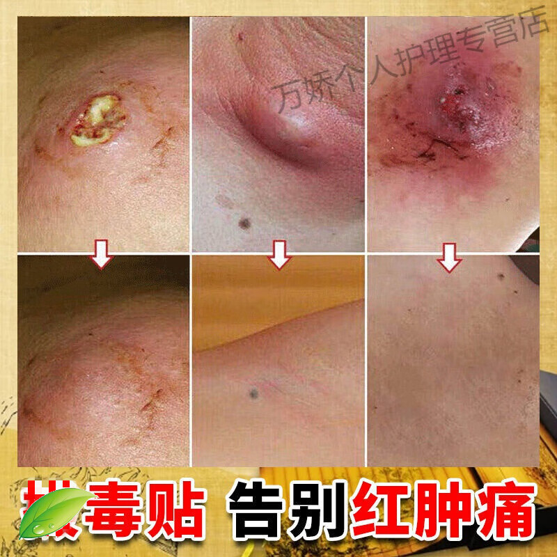 火疖子拔l毒拔脓膏消脓包硬疙瘩表皮红肿疼痛发热流脓水专用特l孝贴