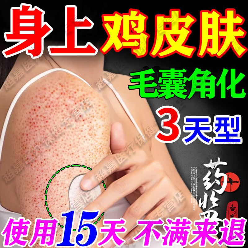 去鸡皮肤疙瘩毛囊角化症专用膏药去除神器儿童脸部毛囊角质疙瘩大腿