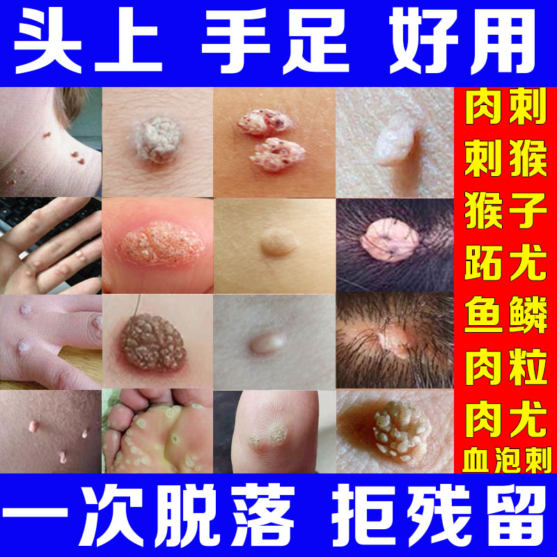 治瘊子的药肉刺去除膏刺猴去除点取鱼鳞痣贴头跖疣老鼠净 跖疣老鼠净