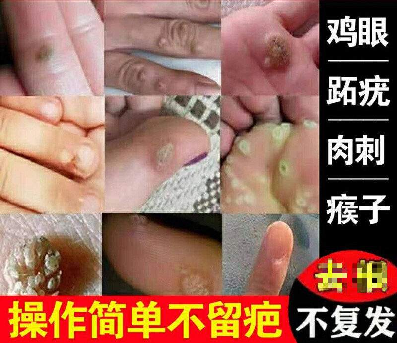 治鸡眼跖i疣寻常l疣瘊i子去刺猴子肉i刺鸡眼膏i病毒疣拓l疣去i疣灵特i