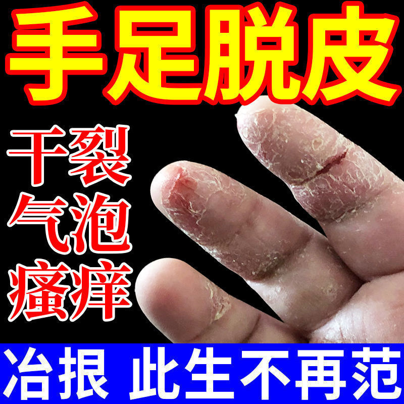 手脚脱皮膏手指脱皮手干脱皮季节性脱皮水泡手干裂脚后跟干裂滋润霜防