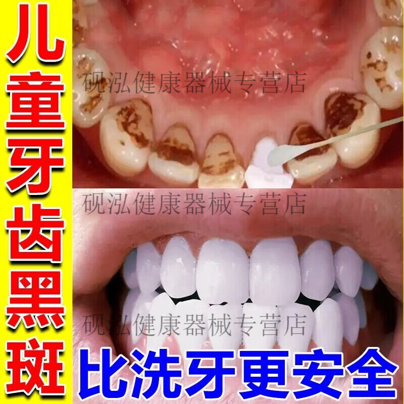 牙菌斑牙膏儿童牙齿美白结石牙渍黄黑斑牙齿益菌牙膏非牙科分离剂 支