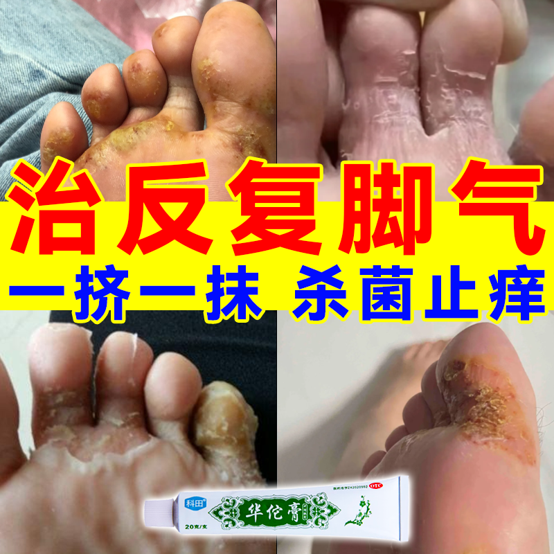 治疗脚气脚臭真菌感染的药止痒长水泡脱皮红肿烂脚丫真菌感染杀菌止痒