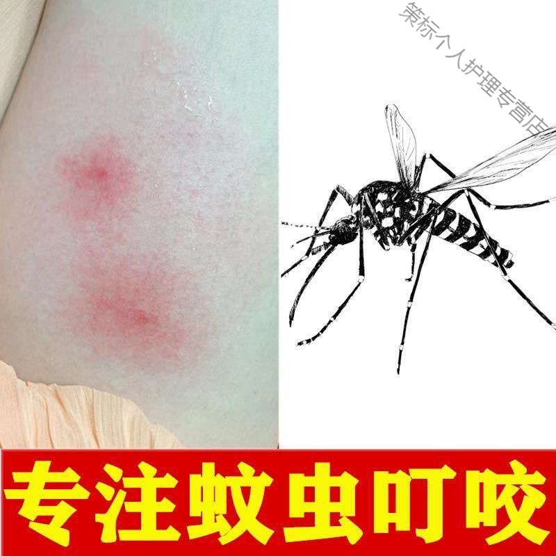 被毒虫红蚂蚁咬伤螨虫跳蚤蚊虫叮咬止痒消i肿皮肤瘙痒