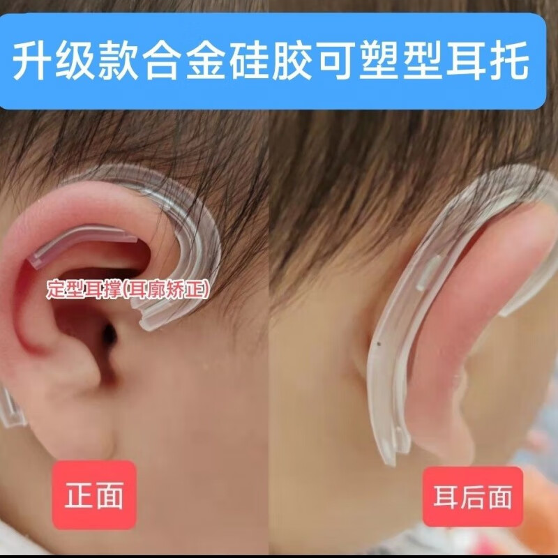 贴面耳纠正器招风耳畸形硅胶耳廓贴宝宝 d26合金耳托一对(新生儿)不