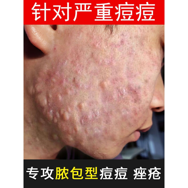 痤i疮膏祛痘重度粉刺闭口去除脸部祛痘印痘坑修复神器痘痘消暗疮炎