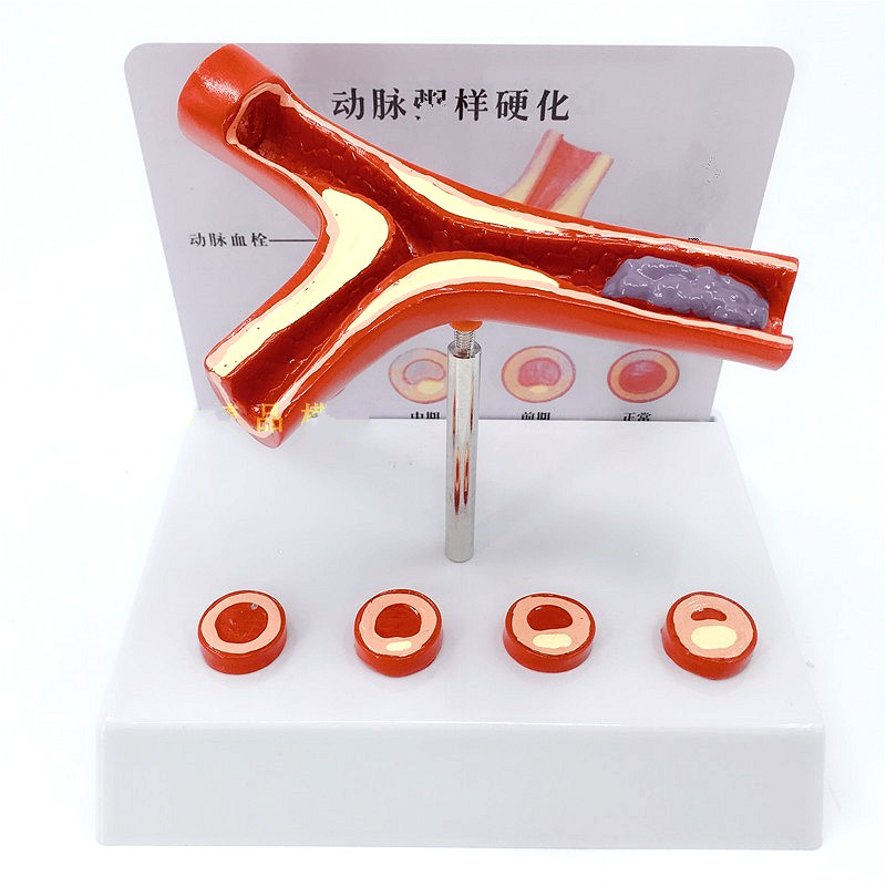 人体血管堵塞解刨模型血液浓度脂肪病理血管稠样血管病理模型 叉样