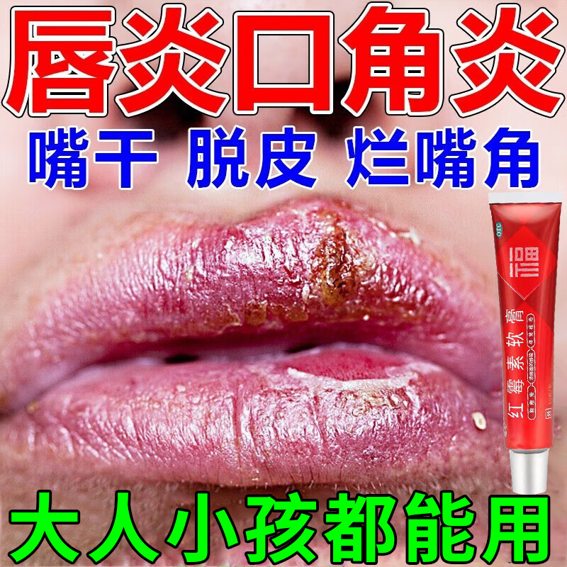 唇炎专用药慢性唇炎嘴唇干裂脱皮起泡疼痛成人儿童口角炎唇膏修复溃烂