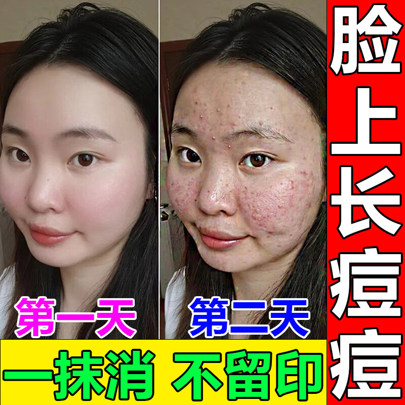 治脸上长痘痘毛l囊炎专用l药脸部下巴额头脓包疙瘩闭口粉刺用什么
