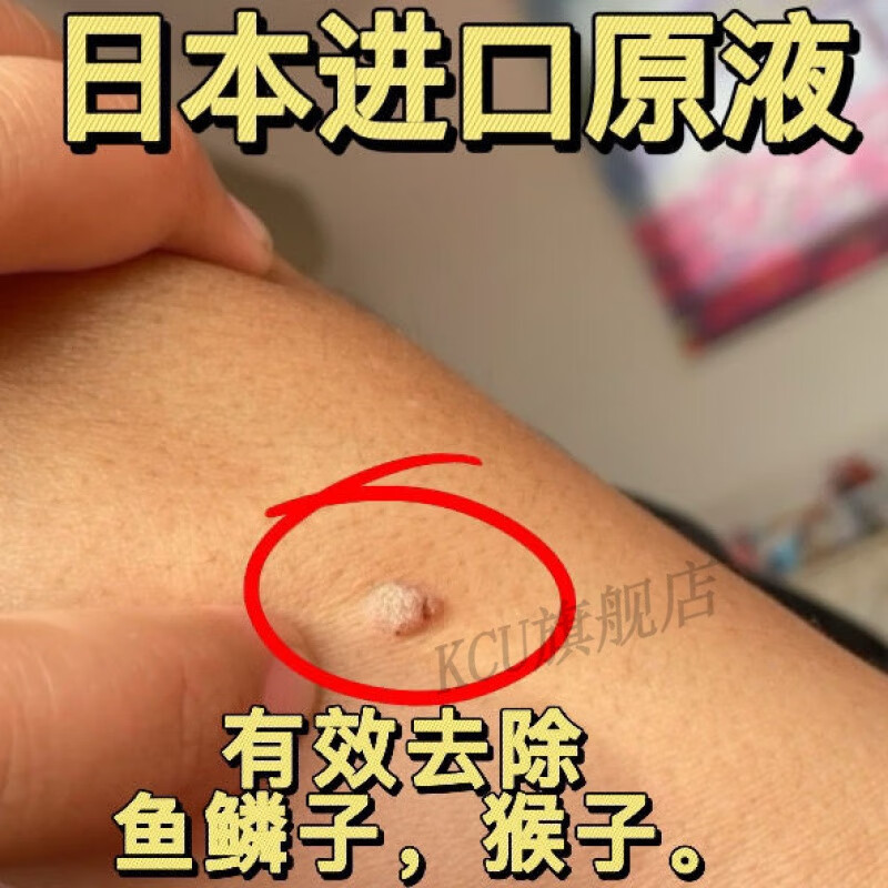 韩芭莎【官方】尤力可清去脖子小肉粒克尤液颈部腋下小猴子祛丝状尤