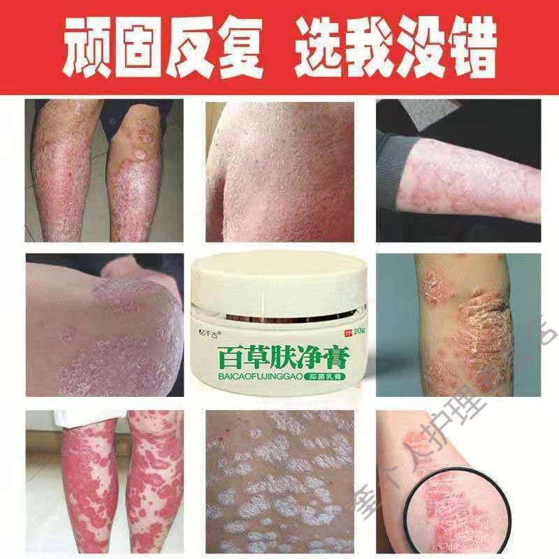 成人皮肤瘙痒真菌感染抑菌止痒薬膏专用手足i藓头l癣皮肤瘙痒皮l炎濕l