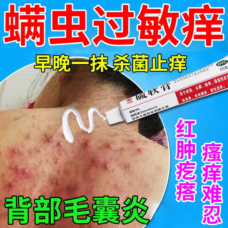 螨虫过敏药膏 螨虫叮咬止痒消肿毛囊炎背部专用药红疙瘩胸部脸部 皮肤
