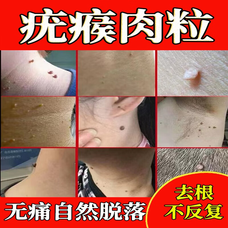 瘊子去除特的效药去除i扁平疣专用的药去i疣一抹灵治疗祛疣瘊子去脖子