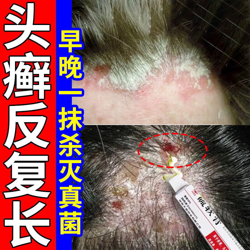 头癣专痒成人用药膏 头癣头皮痒脂溢性皮炎银屑头皮癣头上长红疙瘩