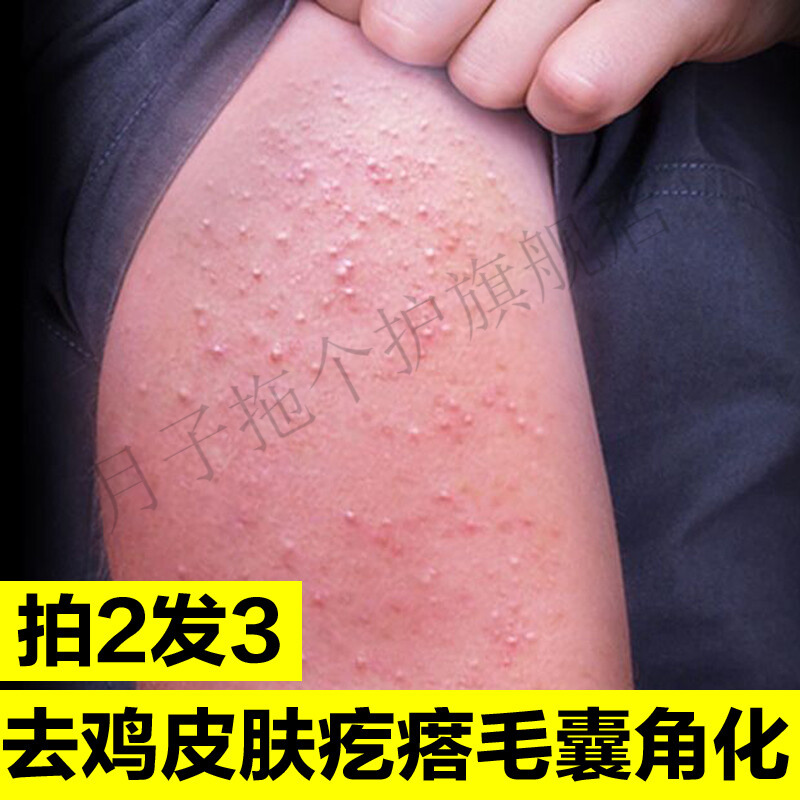 助眠去鸡皮肤（去鸡皮肤用什么效果好）