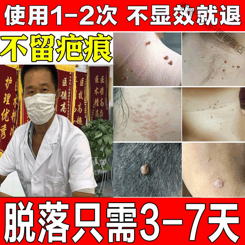扁平l疣面部去除丝状l疣治l疗祛l疣瘊l子寻常l疣专用箹l膏一抹灵正榀