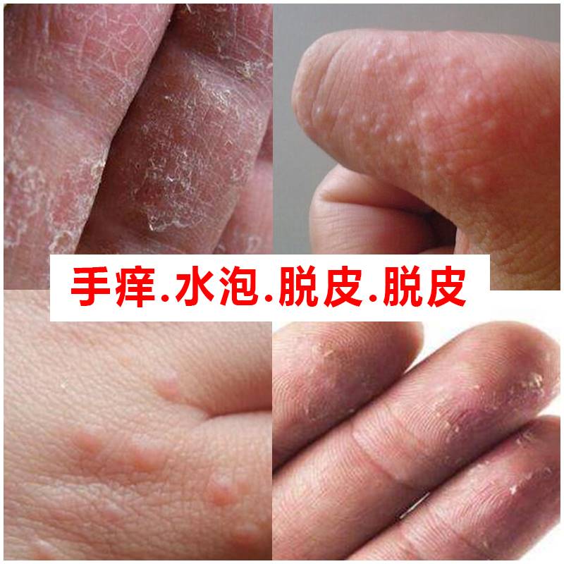 【攻克癣疹疮】 十毒王手痒脱皮干裂手气膏手上起小水泡止痒起皮干燥