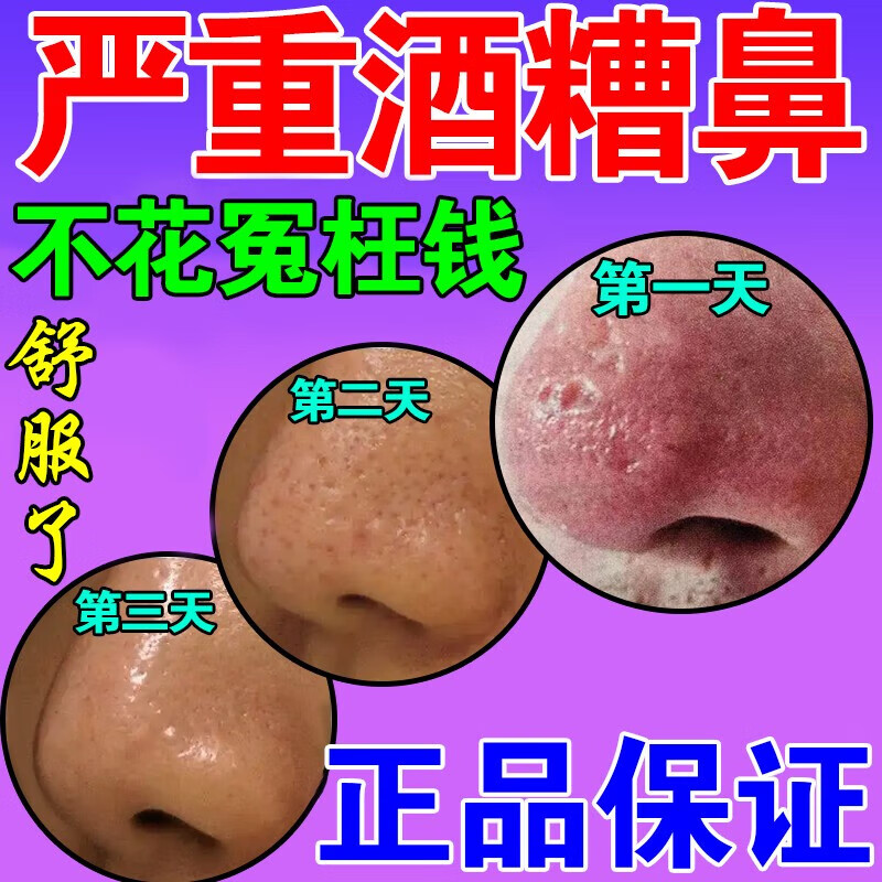 酒糟鼻专用修复药草莓鼻去黑头粉刺红鼻子红血丝收缩毛孔凝胶膏 单盒