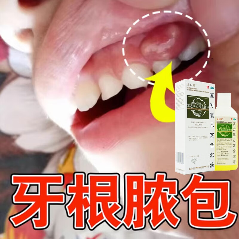 复方氯己定含漱液 牙龈脓包肿包肿痛消焱上火智齿发炎牙根周焱鼓包