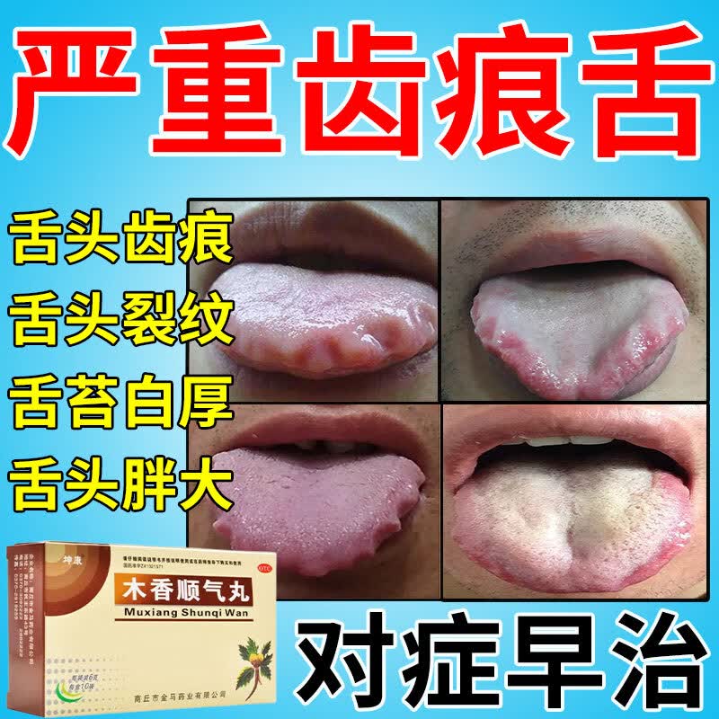 齿痕舌吃什么药】健脾祛湿药脾胃虚弱湿气重引起的舌苔白厚齿痕裂纹