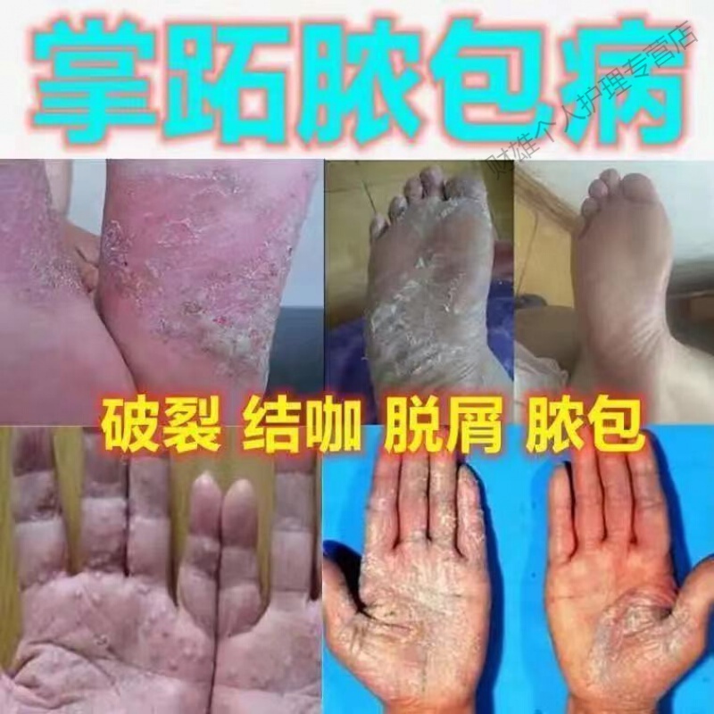 手膏x癣手足膏癬真菌感染脱皮干裂水泡湿掌跖脓包病掌