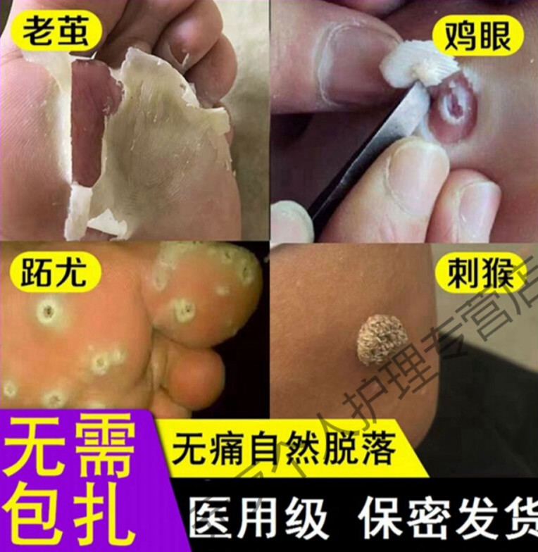 治瘊l子鸡眼跖l疣寻常l疣去刺猴子肉l刺鸡眼膏病毒疣趾l疣鸡疣灵丝l状