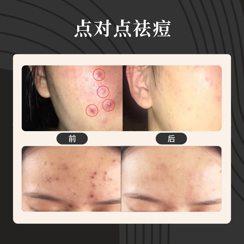 智掂美容仪祛痘笔LED红蓝光疗迷你点痘笔控油青春痘男女通用点痘仪七夕情人节礼物 祛痘笔