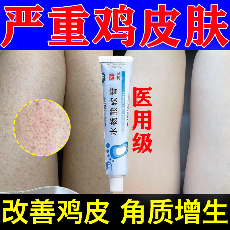 鸡皮肤疙瘩毛囊角化症专用otc药膏 水杨酸软膏 去鸡皮肤毛囊角质疙瘩