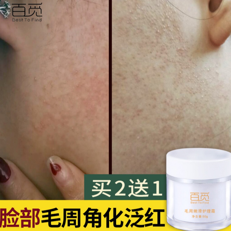 鸡皮肤疙瘩毛囊角质鸡皮膏去i除脸上祛脸部脸颊去适用毛周角化软膏