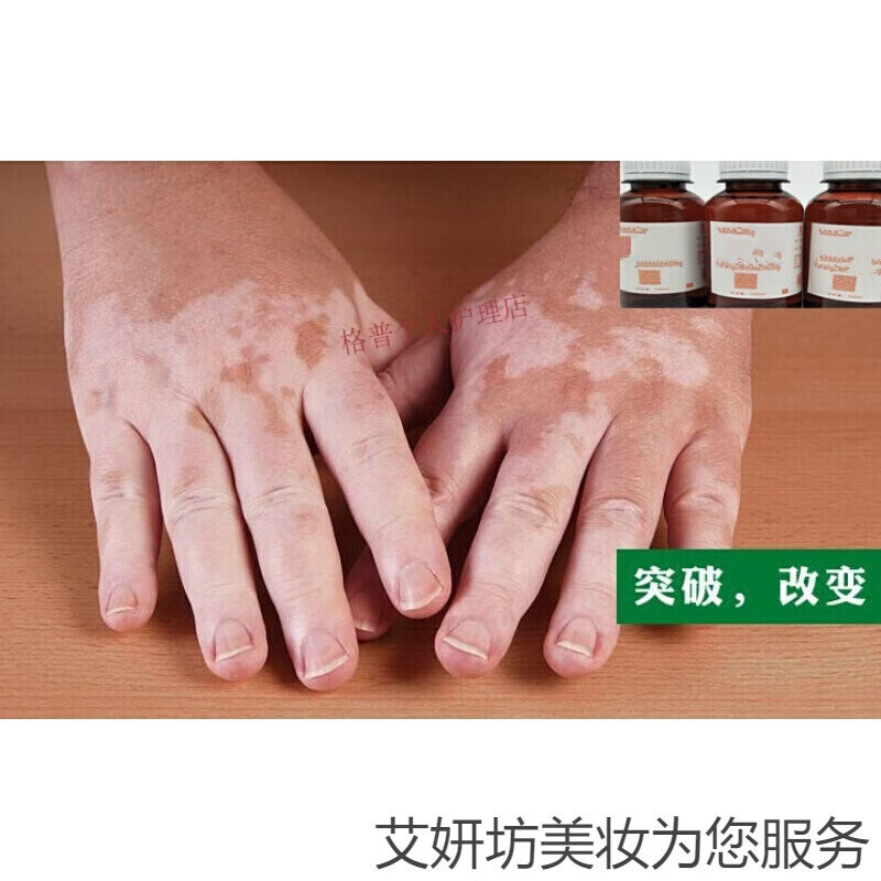 广雅白之选复方补骨脂酊外用促黑色素生成白癜净修复液消白宁50ml