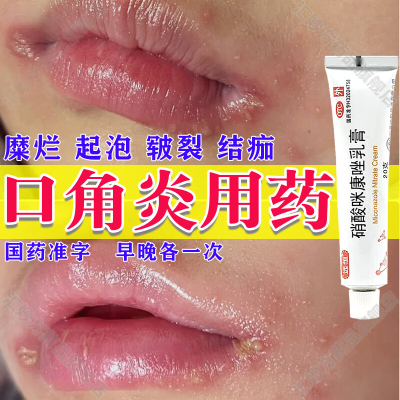 口角炎烂嘴角药膏儿童 嘴角开裂嘴角溃烂软膏口角炎专用otc药口周皮炎