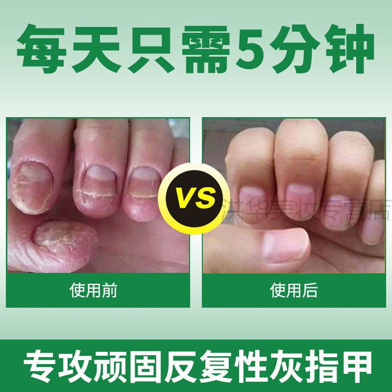 一滴去灰甲灰指甲特效箹液灰甲克星去除灰指甲抑菌液 买三 二
