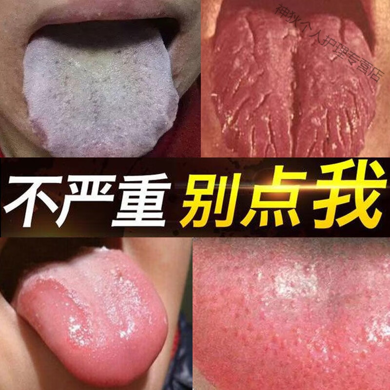 舌康灵口腔扁平苔l藓【一喷就灵】舌炎口腔黏膜溃疡白斑纹糜烂口腔