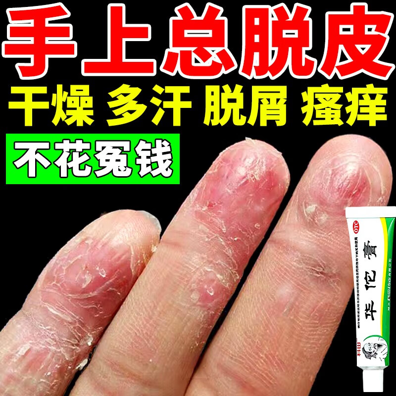 痒脱皮干裂水泡脱皮真菌感染手皮开裂干裂 手气真菌感染止痒华佗膏