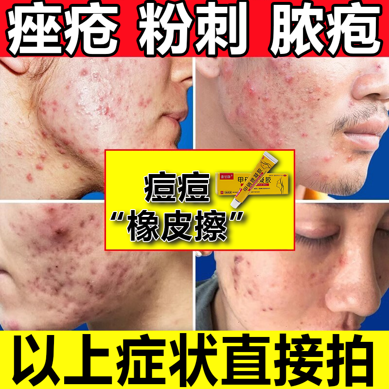 凝胶用于痤疮(为粉刺,丘疹,脓疱,结节,囊肿以及瘢痕等特征)的局部治疗