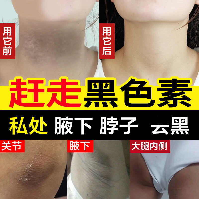 【去除黑l色素】大腿内侧腋窝黑脖子手臂棘皮身体美i白去l黑色素沉淀