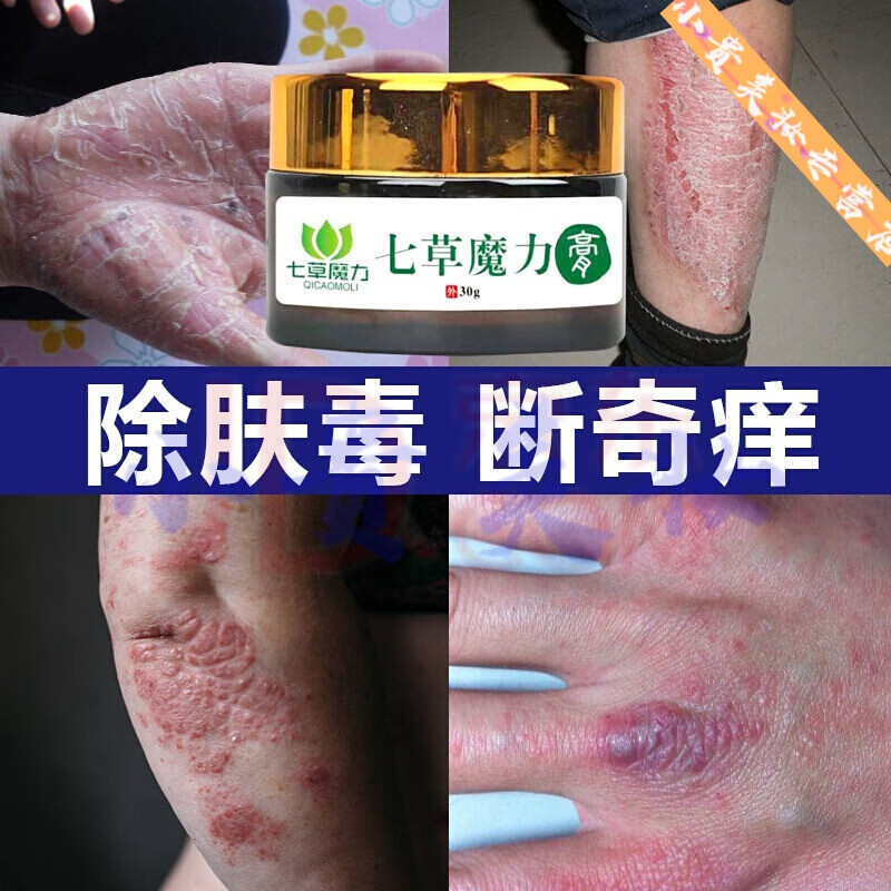 手x癣手足哫癣真菌感染汗h疱b疹水泡手痒脱皮干裂湿紾