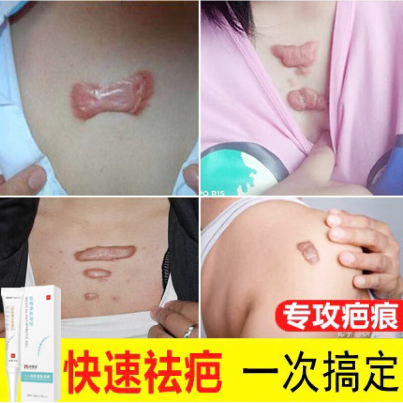 严重疤痕淡化膏 去除增生疤痕疙瘩凸起软化胸前瘢痕体质伤疤手术疤痕
