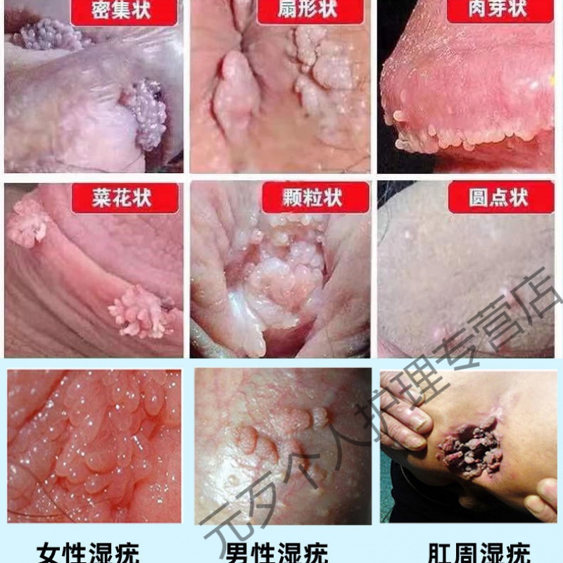 去除l尖锐湿疣男女私处疣病毒感染肛周gui头阴l茎肉l刺除疣te效防反复