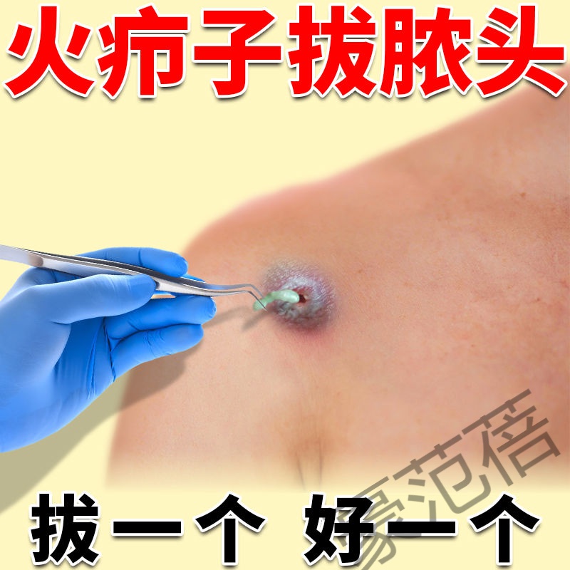 火疖子拔l毒膏火疙瘩红肿硬结发热痛痒流脓红疙瘩拔l脓拔l毒膏贴特效