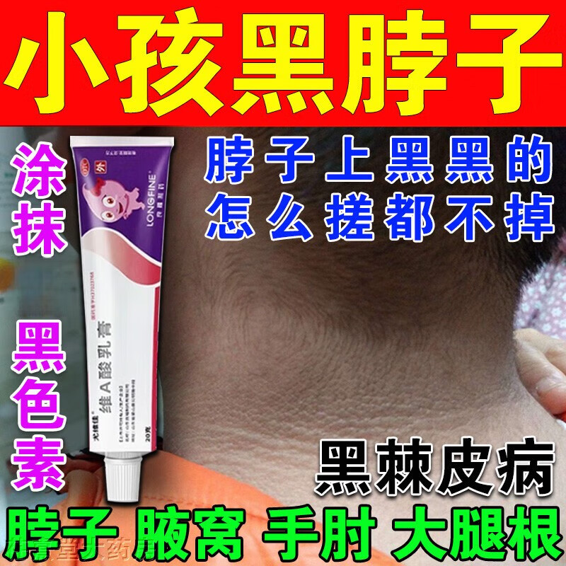 维a酸乳膏黑棘皮病 脖子黑色素药膏关节黑 药膏大腿根私处发黑小孩