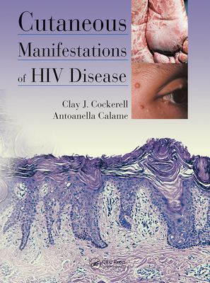 【预订】cutaneous manifestations of hiv