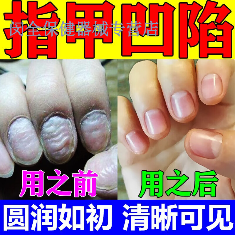 药房直售 指甲凹凸不平手脚甲内陷薄软白点坑洼美甲增厚亮营养修 单