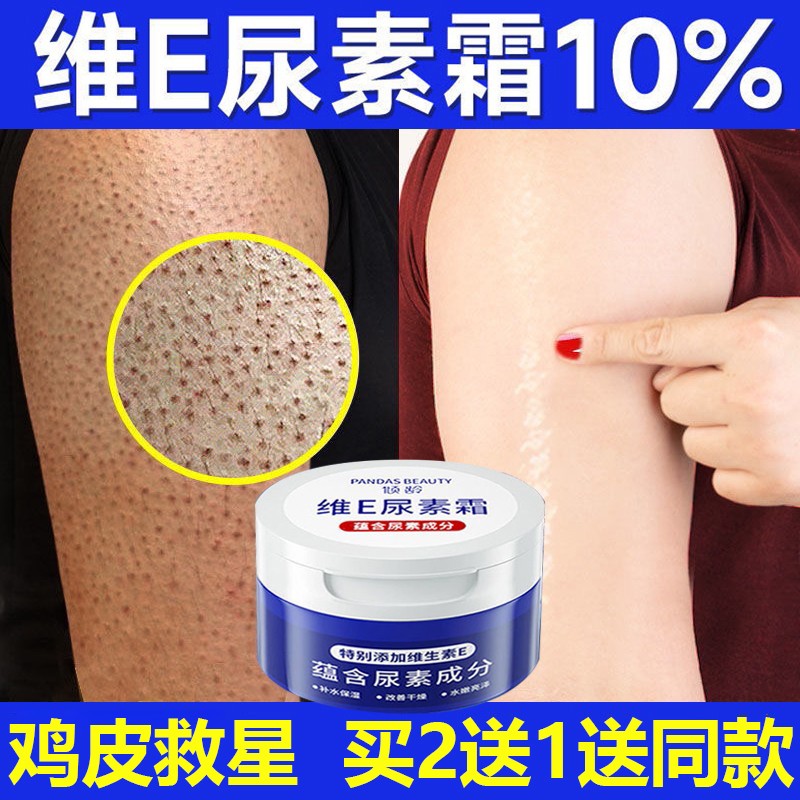 尿毒软膏可以去鸡皮肤吗(尿素乳膏可以去除鸡皮肤吗)